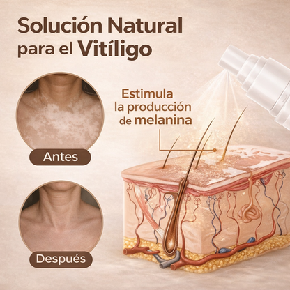 Evenora Herbal Spray TT.A - Solucion natural para el vitiligo