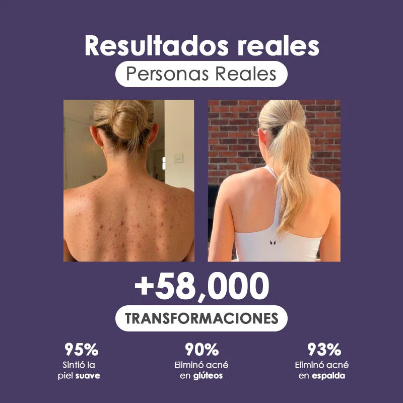 Naturalú Spray™ para eliminar acné corporal y manchas en la piel