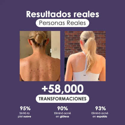 Naturalú Spray™ para eliminar acné corporal y manchas en la piel